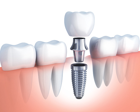 Implant Restoration - Midtown Dental Studio